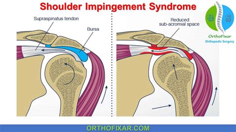 positive shoulder impingement test